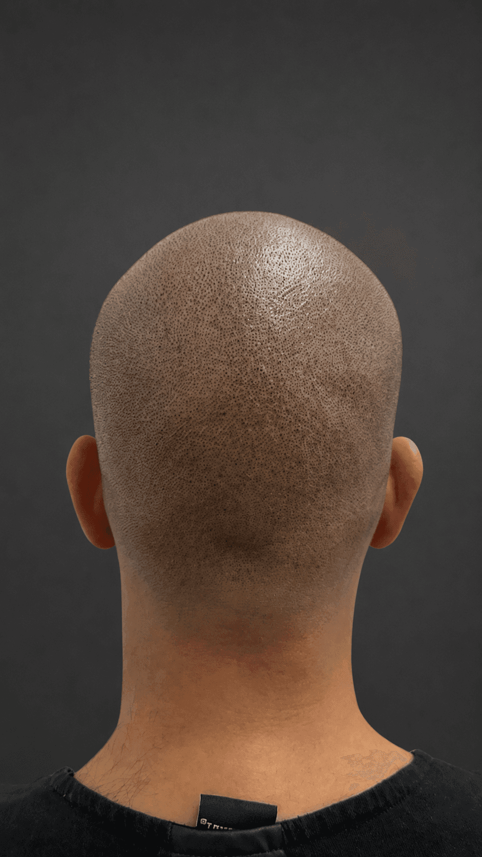 Reconstrucción de Injertos